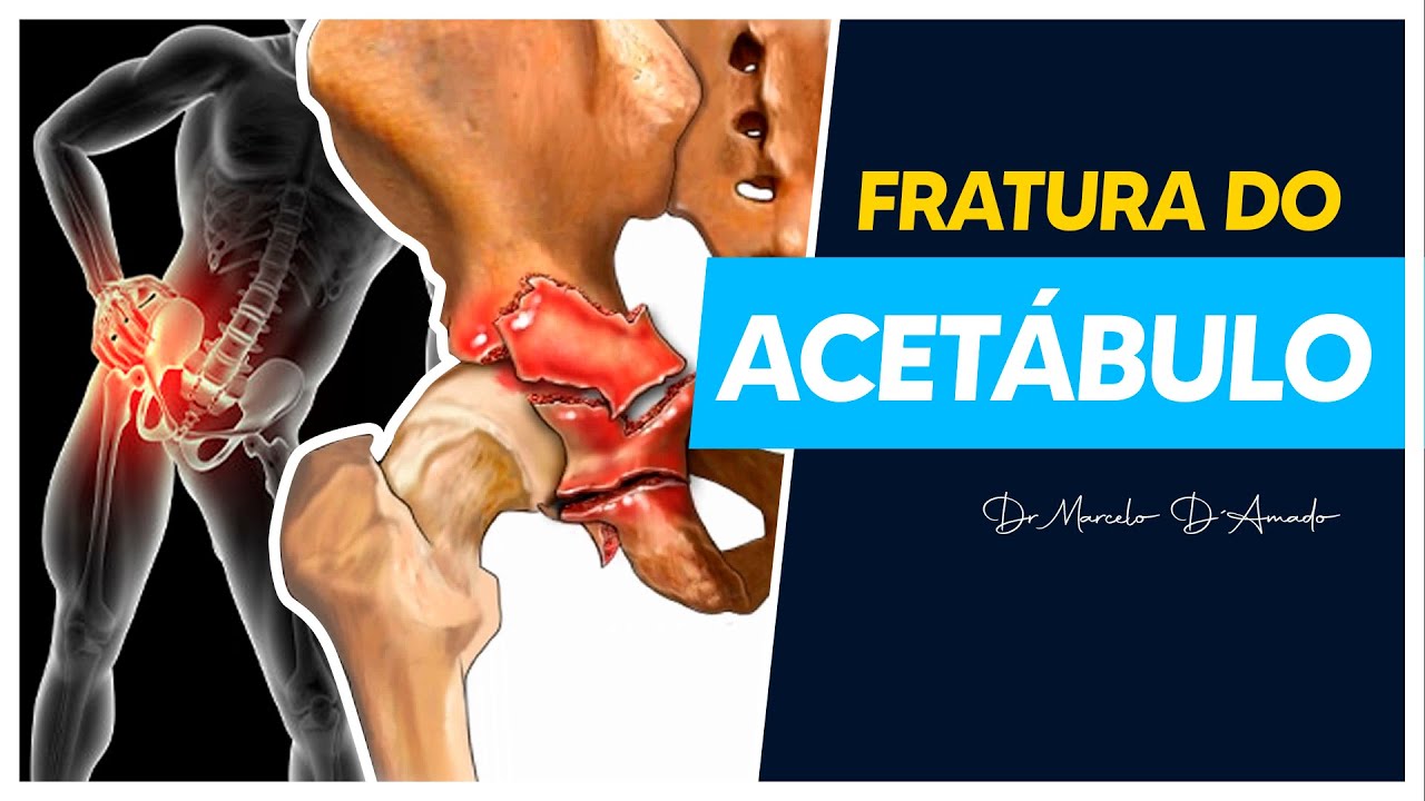 TUDO O QUE VOCÊ PRECISA SABER SOBRE FRATURA DO ACETÁBULO | TRATAMENTO E RECUPERAÇÃO