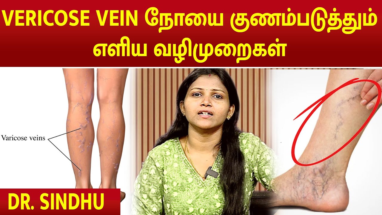 VERICOSE VEIN நோயை குணம்படுத்தும் எளிய வழிமுறைகள் #vericoseveins #vericoseveintreatment #megatv