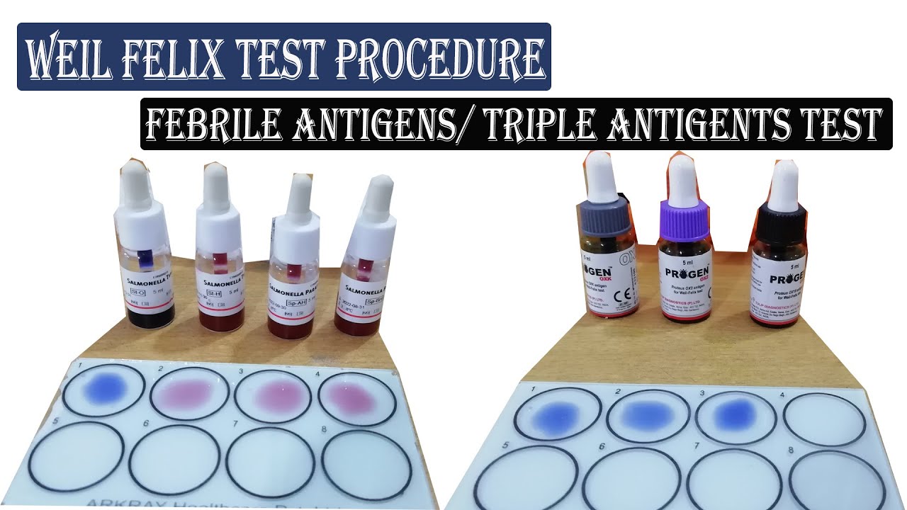 Weil Felix Test ।। Febrile Antigens/ Triple Antigens Test Procedure Full Details.