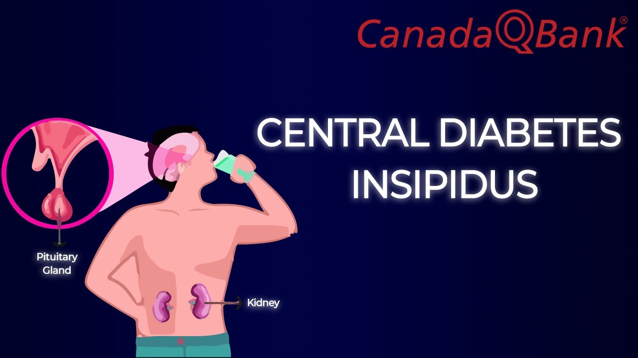 Central Diabetes Insipidus