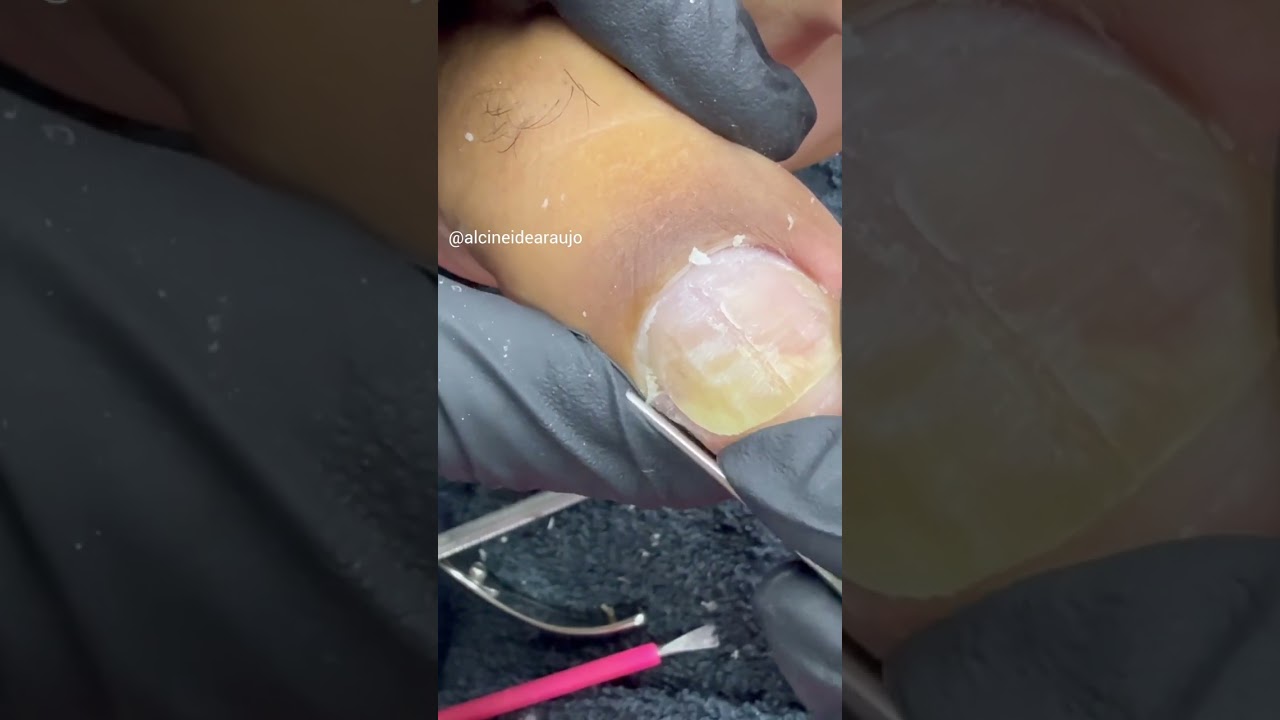 Cutícula fina eu não gosto muito prefiro pegar um pé com bastante cutícula aquela bem grossa ☺️