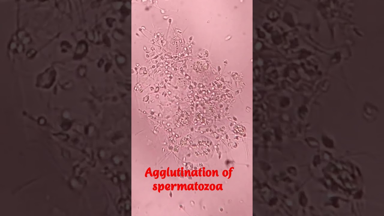 Sperm agglutination 🔬🔬#shorts #dmlt #bmlt #lab_technician #lab_assistant_2022 #pathology