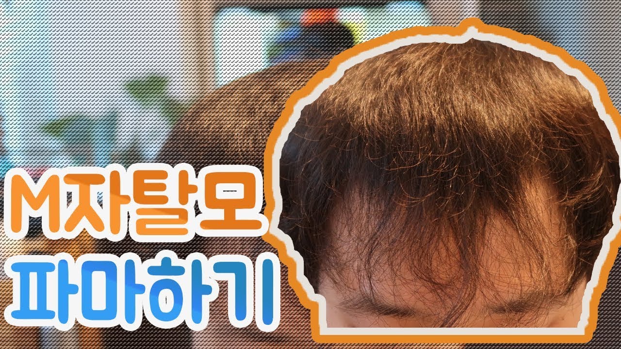 M자탈모 헤어스타일!! 이젠 탈모약으로 치료하는게 아니라 탈모 파마로 커버 하기!!