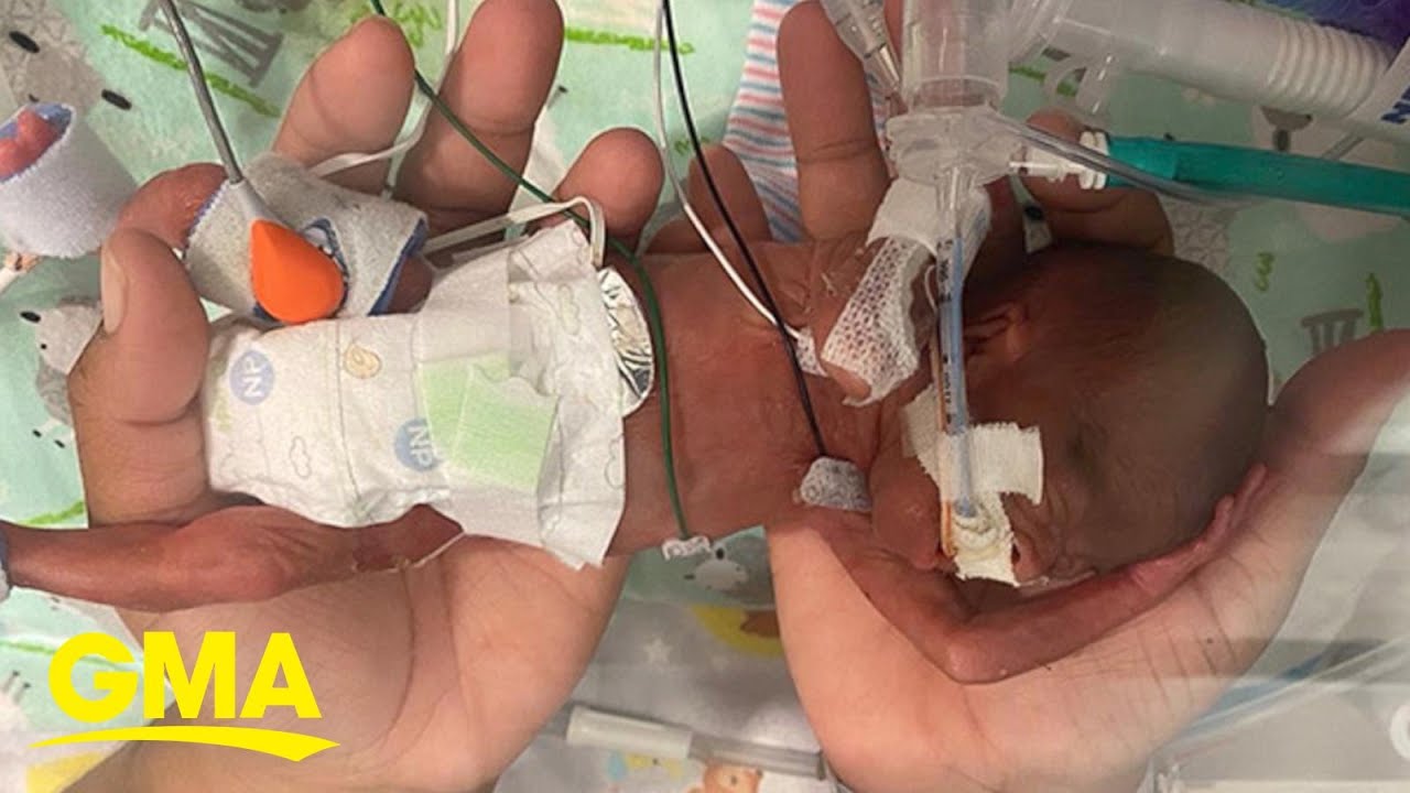 Baby born at 21 weeks named world&rsquo;s most premature infant to survive l GMA