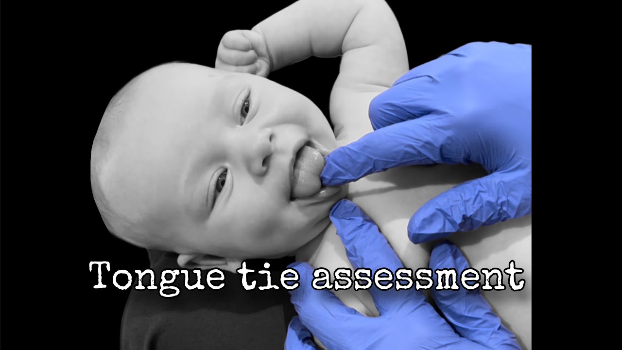Oral motor and tongue tie assessment
