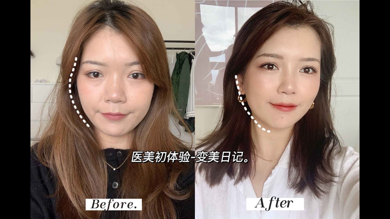 【医美反馈】半年内在脸上花了近10万有什么改变？| 美版超声刀 超皮秒 雷射 玻尿酸
