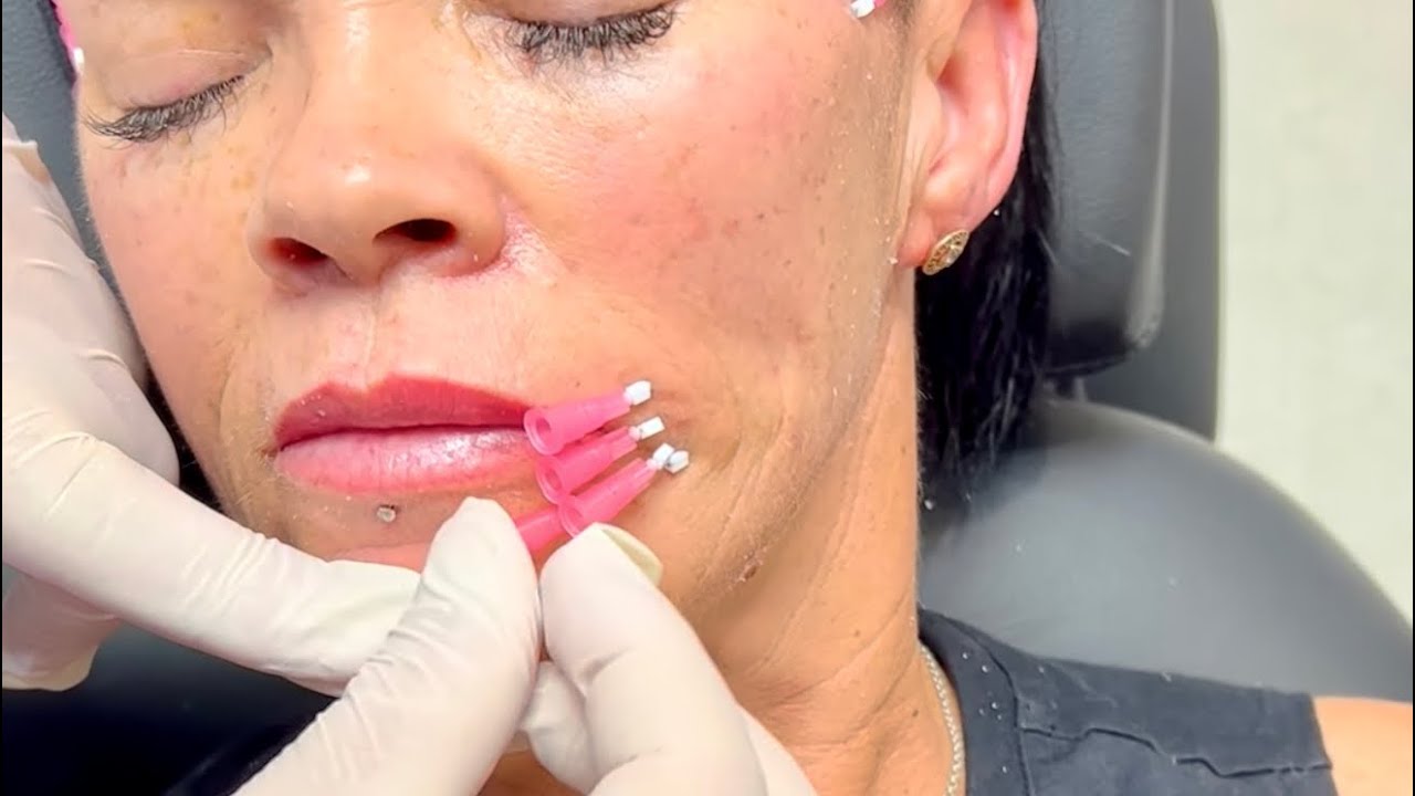 Pdo thread treatment | Newcastle Cosmetic Doctor | Dr Bart Scanlon inserting PDO mint threads