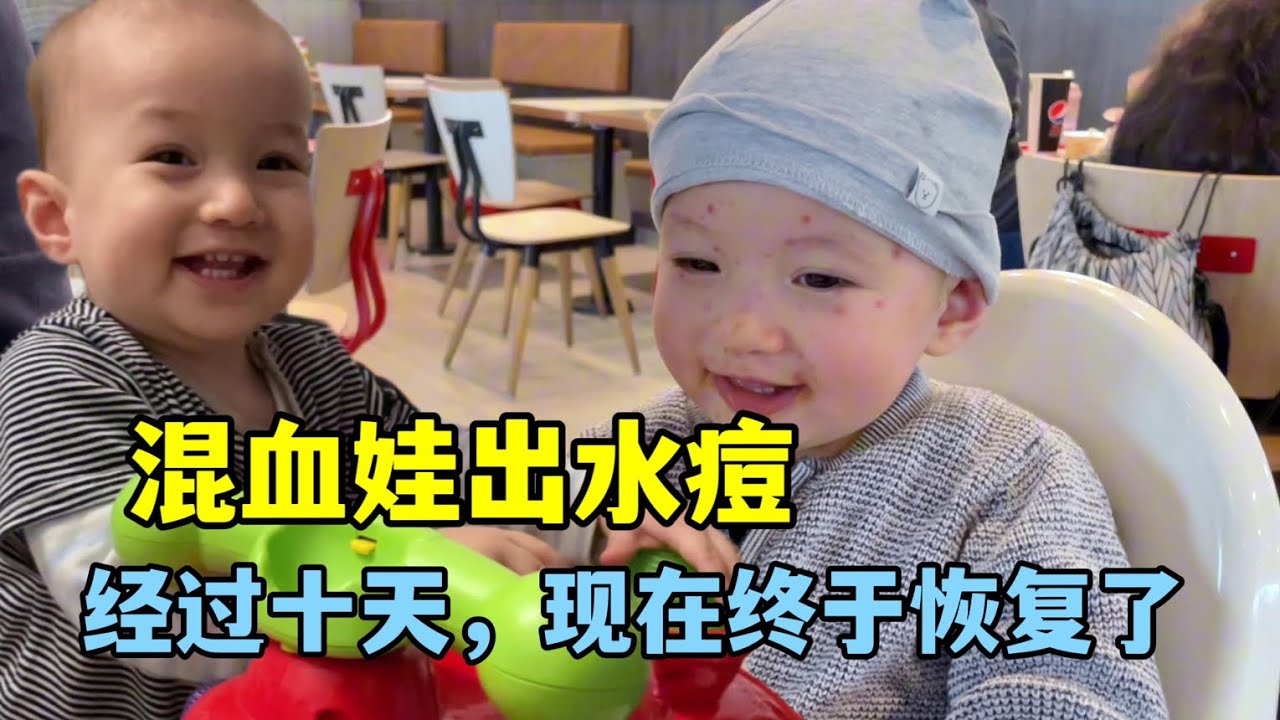 德國二胎生活：弟弟出水痘前後對比，現在基本痊癒，生龍活虎的！