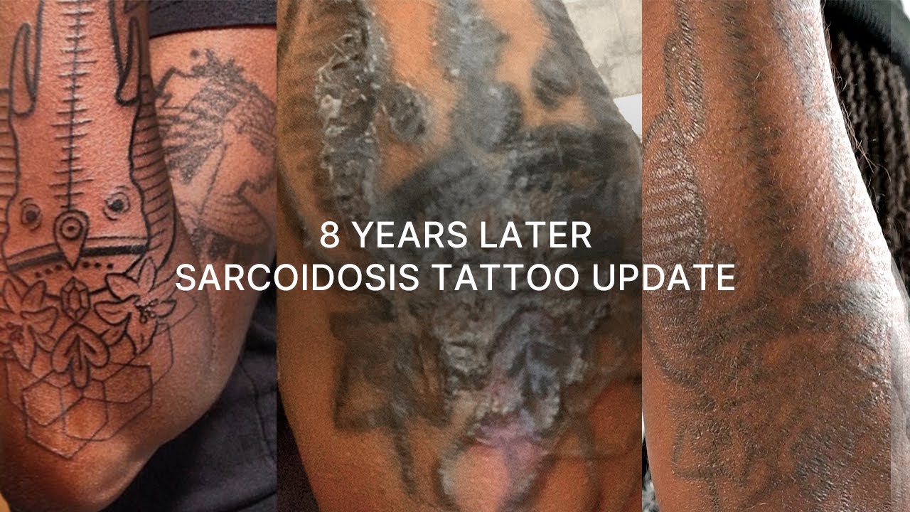 8 years of sarcoidosis: tattoo update