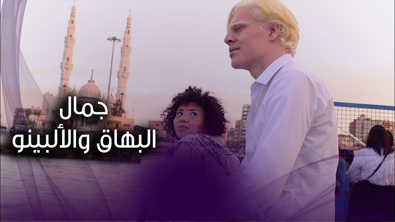 أجمل فيديو عن التميز.. البهاق والألبينو غير حياة آلاء وزياد