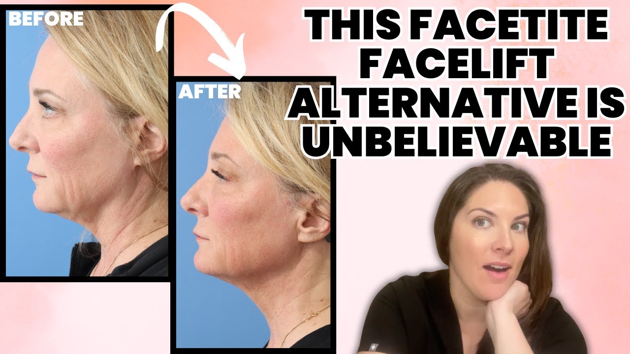What Getting a FaceTite 