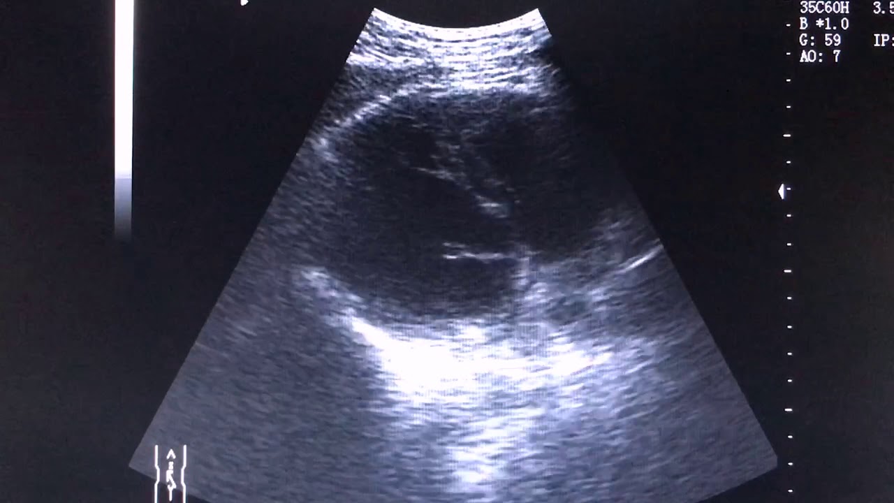 不整脈心エコー（心音付き） Echocardiography with irregular heartbeat sound