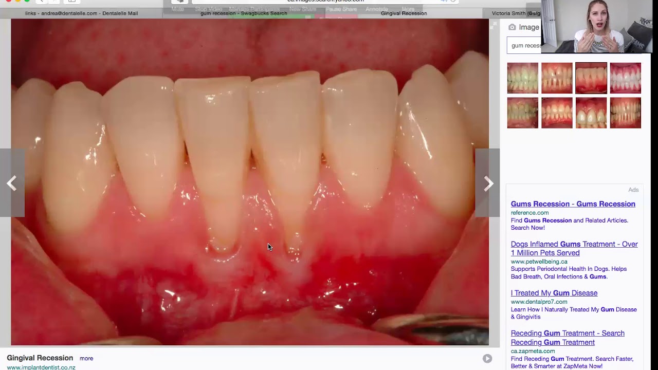 How to Explain Gingival Recession to Your Patients
