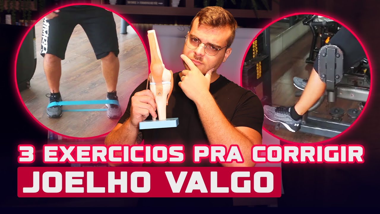 JOELHO VALGO: Acabe com a Dor do seu aluno. 3 Exercícios para Corrigir! | João Franken