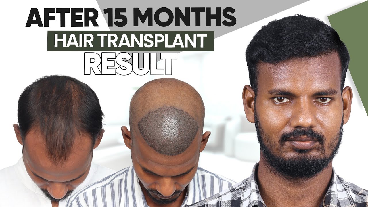 Hair Transplant in Ahmedabad | Best Results & Cost of Hair Transplant in Ahmedabad