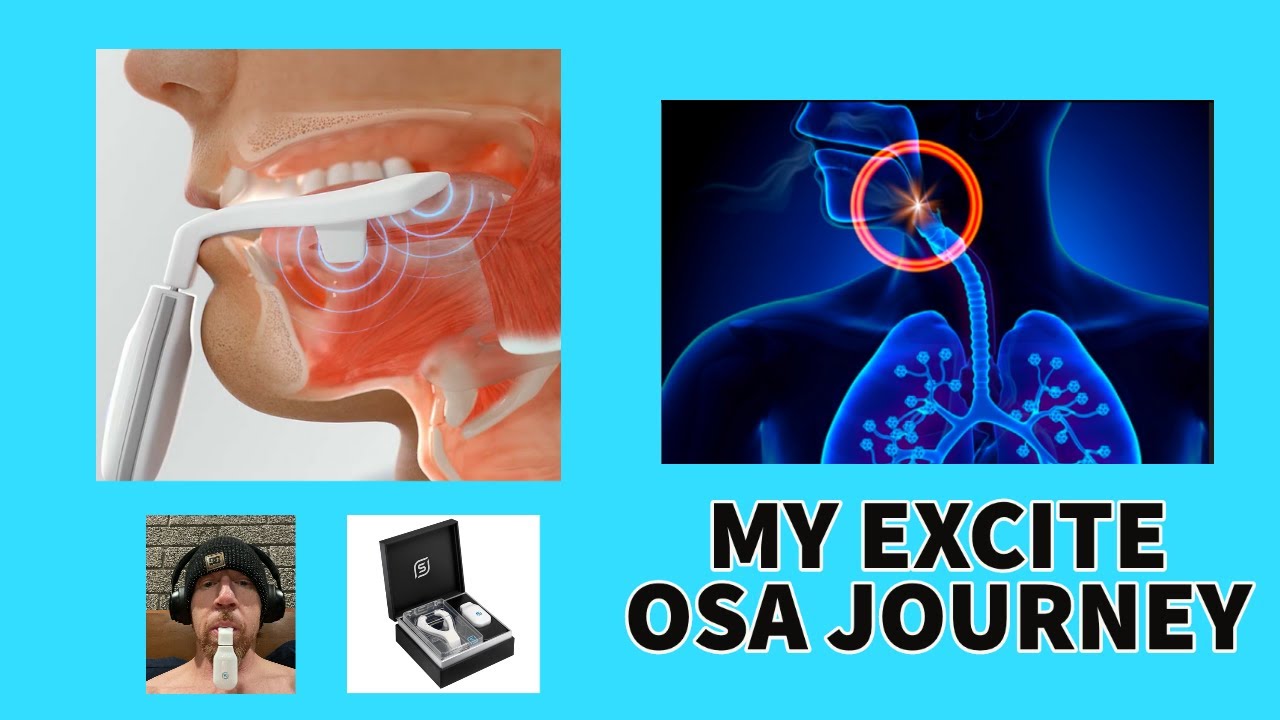 DOES THE EXCITE OSA REALLY HELP WITH SLEEP APNEA AND SNORING???