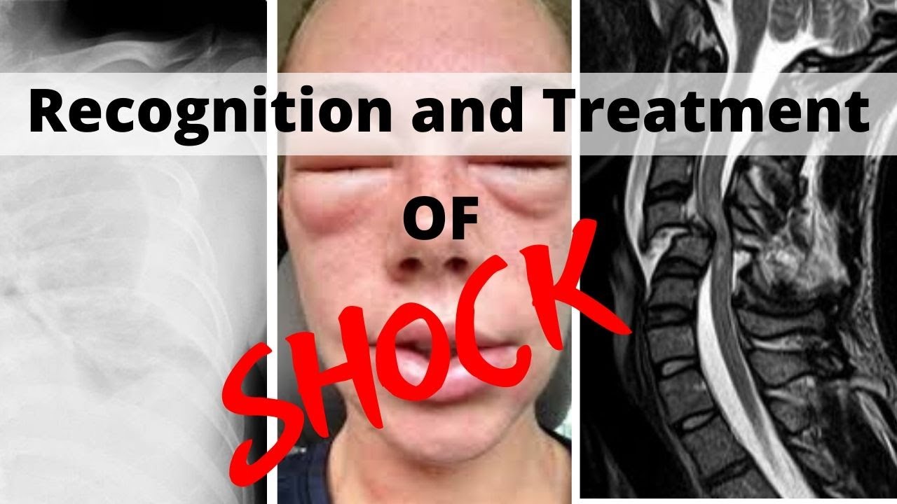 Recognition and Treatment of Shock