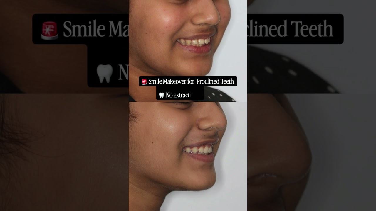 Overbite correction with Invisalign  #smilemakeover #clearaligners