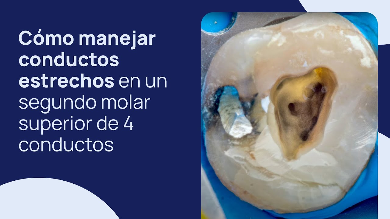 Cómo manejar conductos estrechos en un segundo molar superior de 4 conductos