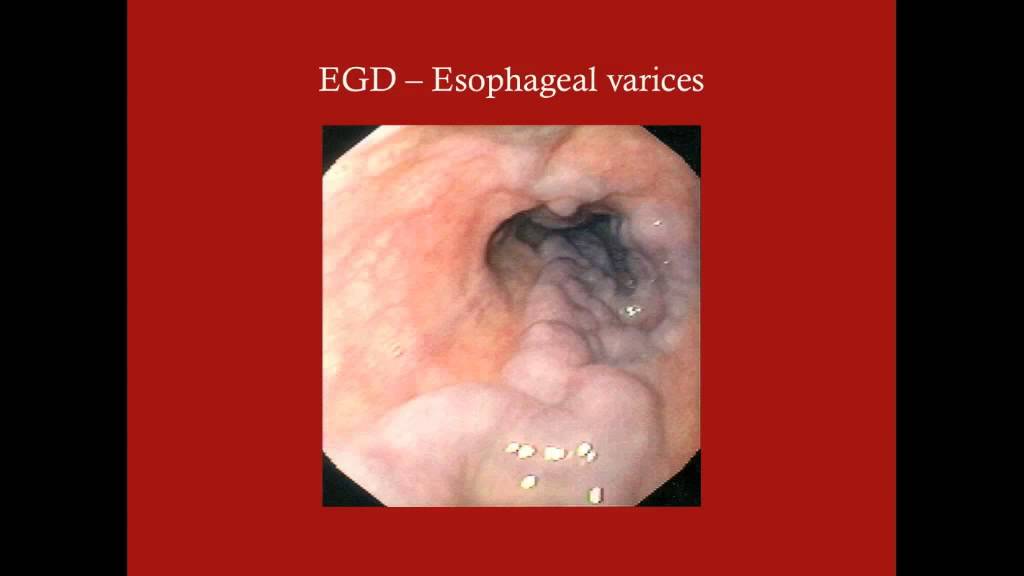 Cirrhosis and Liver Emergencies - CRASH! Medical Review Series