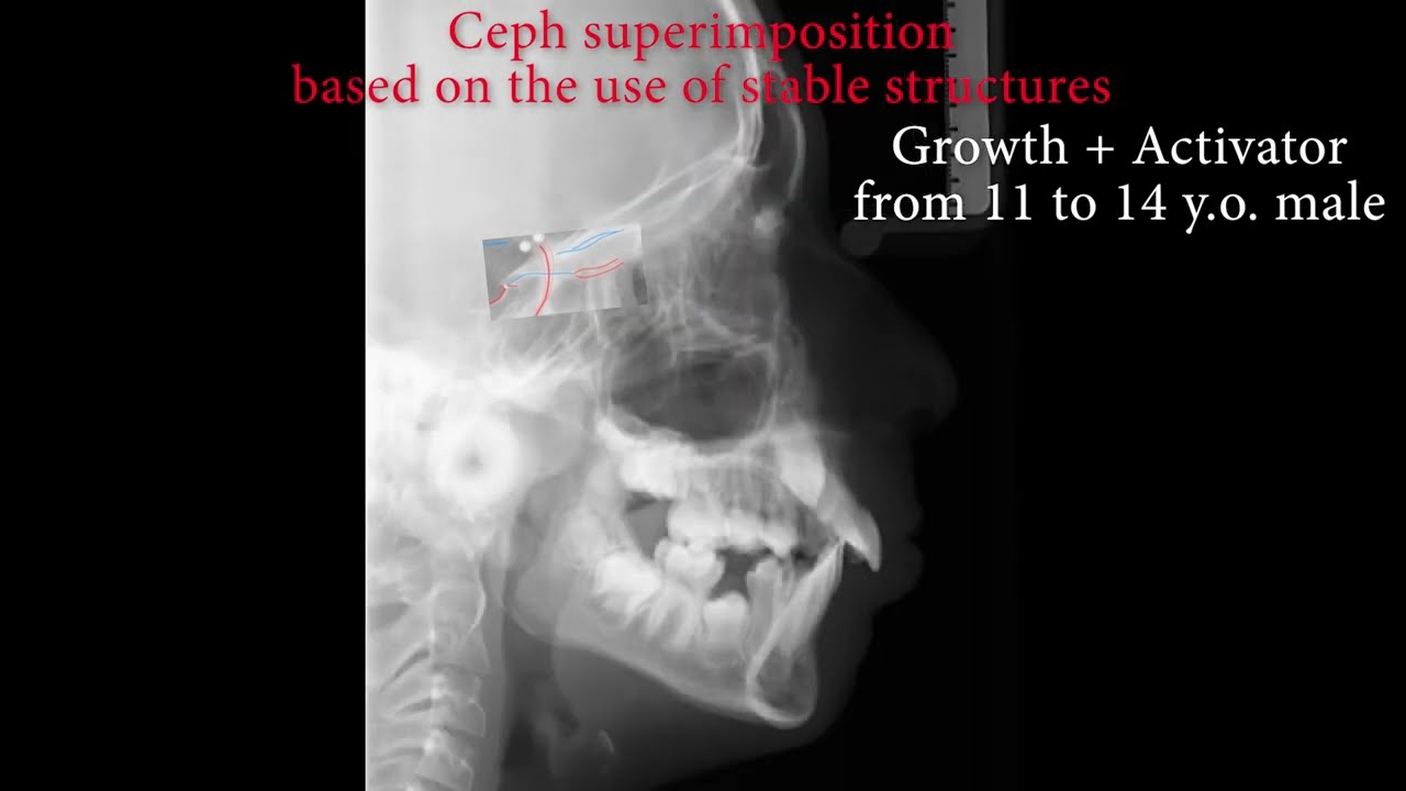 ❤️&zwj;🔥  Ceph Superimposition based on the use of stable structures on a computer. (before AI)