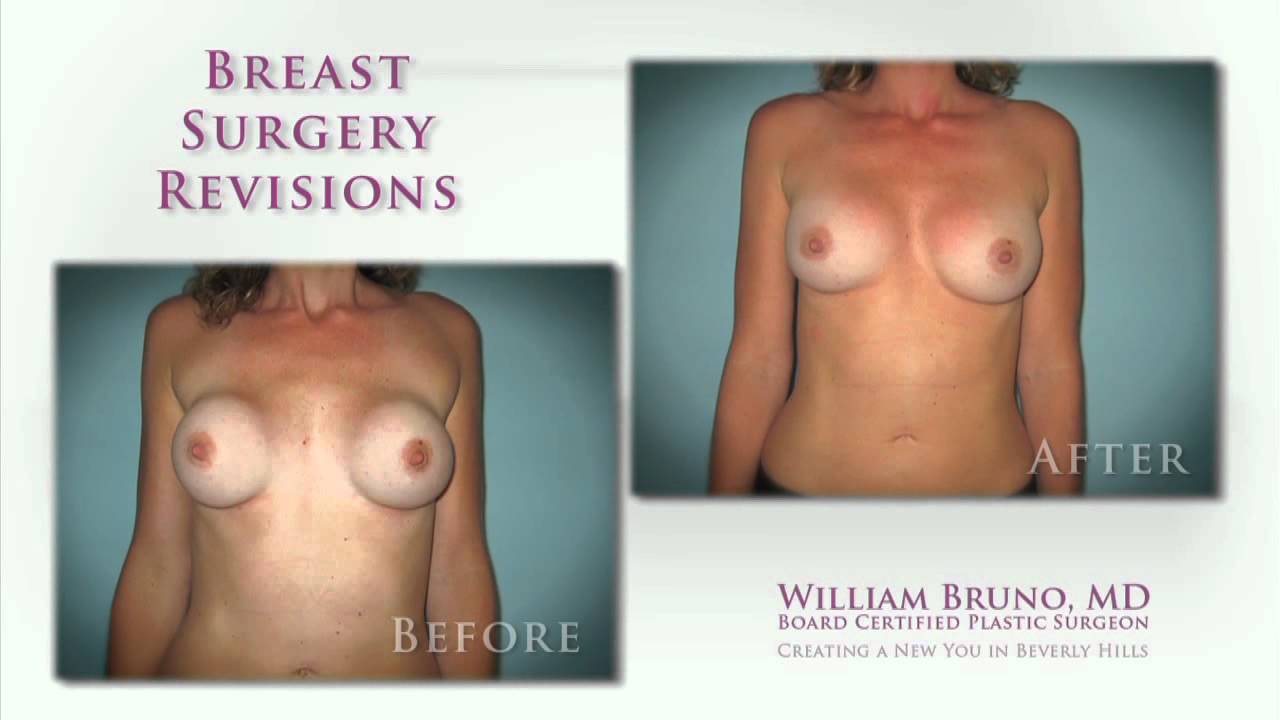 Beverly Hills Breast Implant Revision | Dr. William Bruno