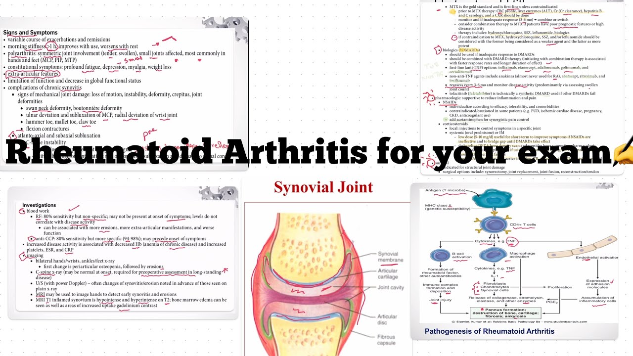 Rheumatoid arthritis for your exam -make it easy