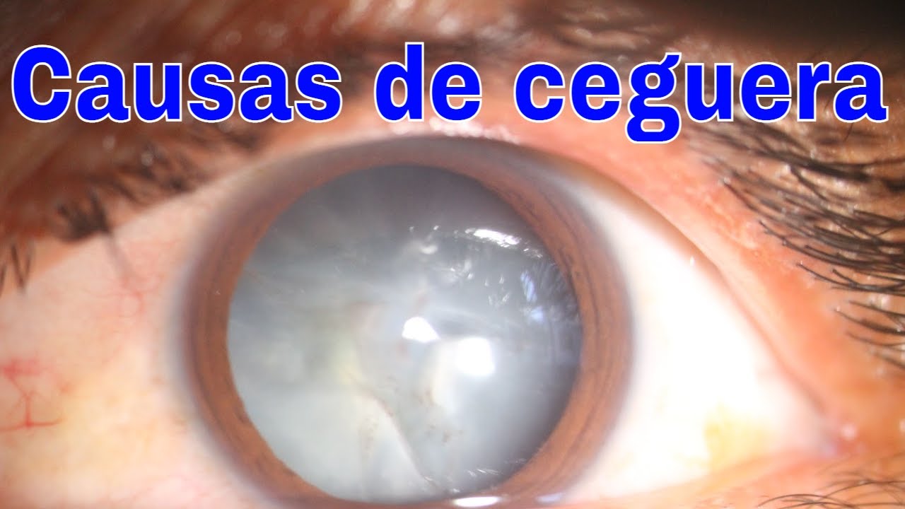 7 Causas más frecuentes de cegera
