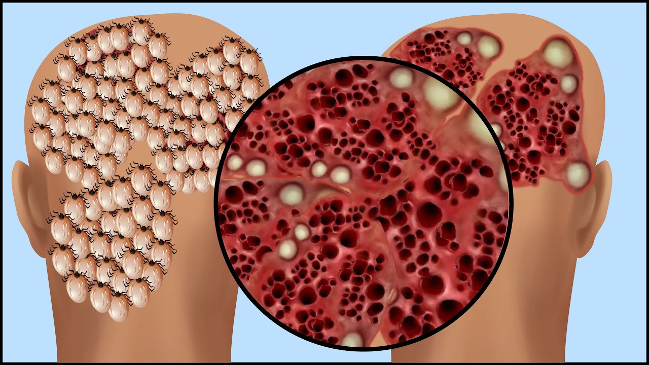 ASMR Treatment Lice and Scabies on the Head  Satisfying Removal Fungal Scalp