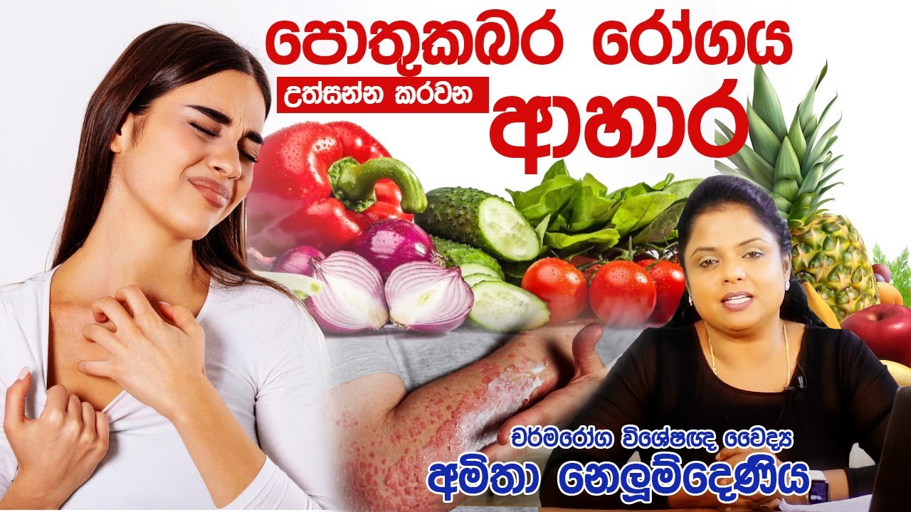 පොතුකබර රෝගය උත්සන්න කරවන ආහාර | Skin Specialist