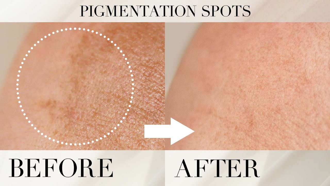 How To Get Rid Of Pigmentation Spots