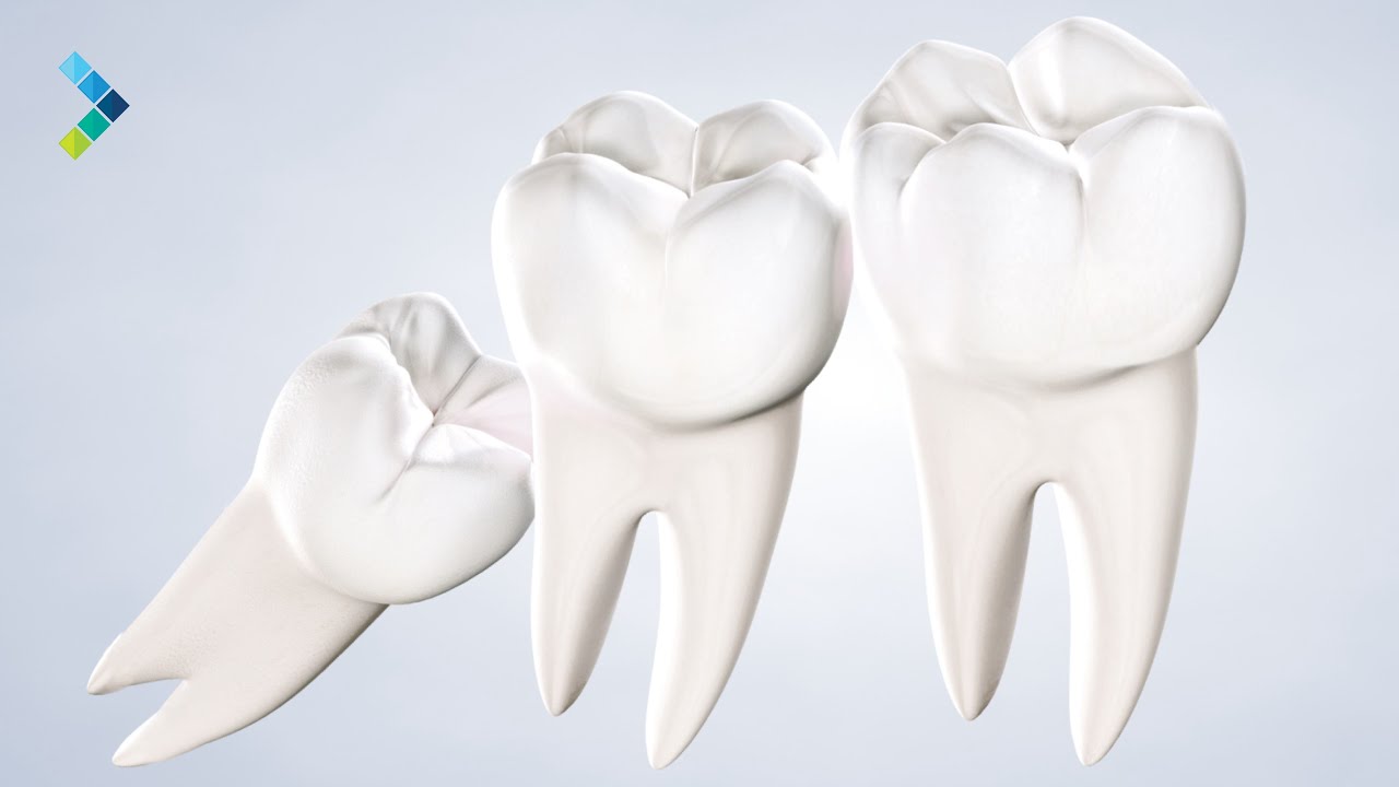 Wisdom Teeth Removal in Louisville, KY