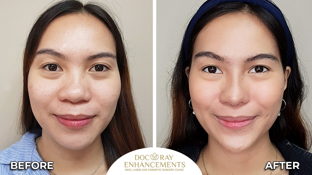 Amazing Transformation After Rhinoplasty and Chin Augmentation by Dr  Raynald Torres