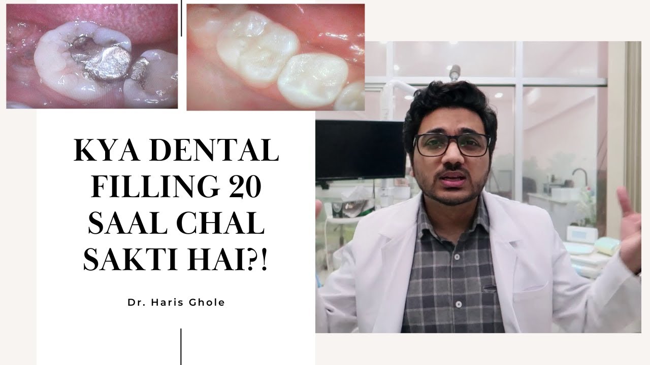 How long does a dental filling last?!