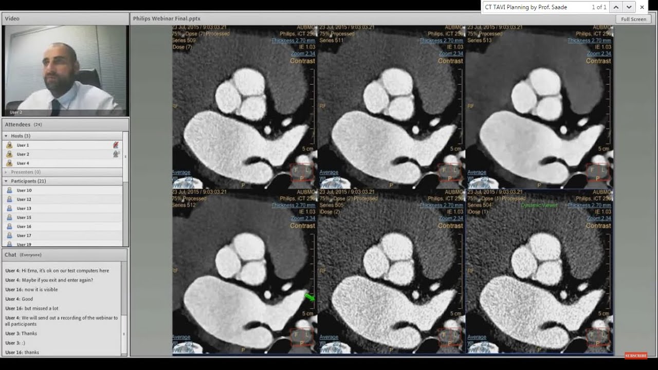Webinar segment 4: CT TAVI Planning by Prof. Saade