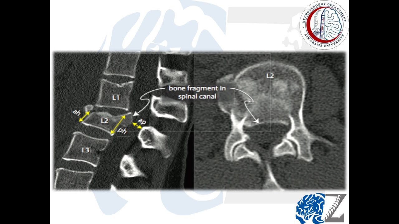 Spine Trauma (23):  Thoraco-Lumbar Spine Fractures (8) : Management of Burst Fractures