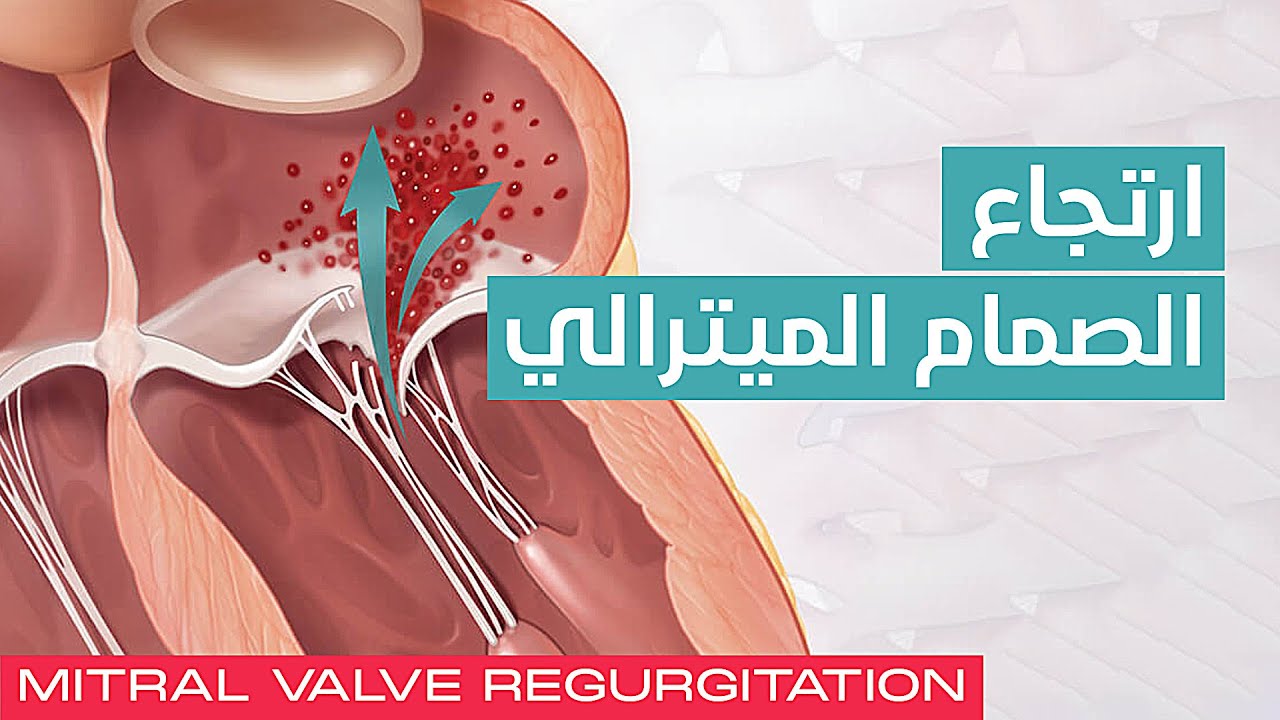 Mitral Valve Regurgitation 💖 ارتجاع الصمام الميترالي