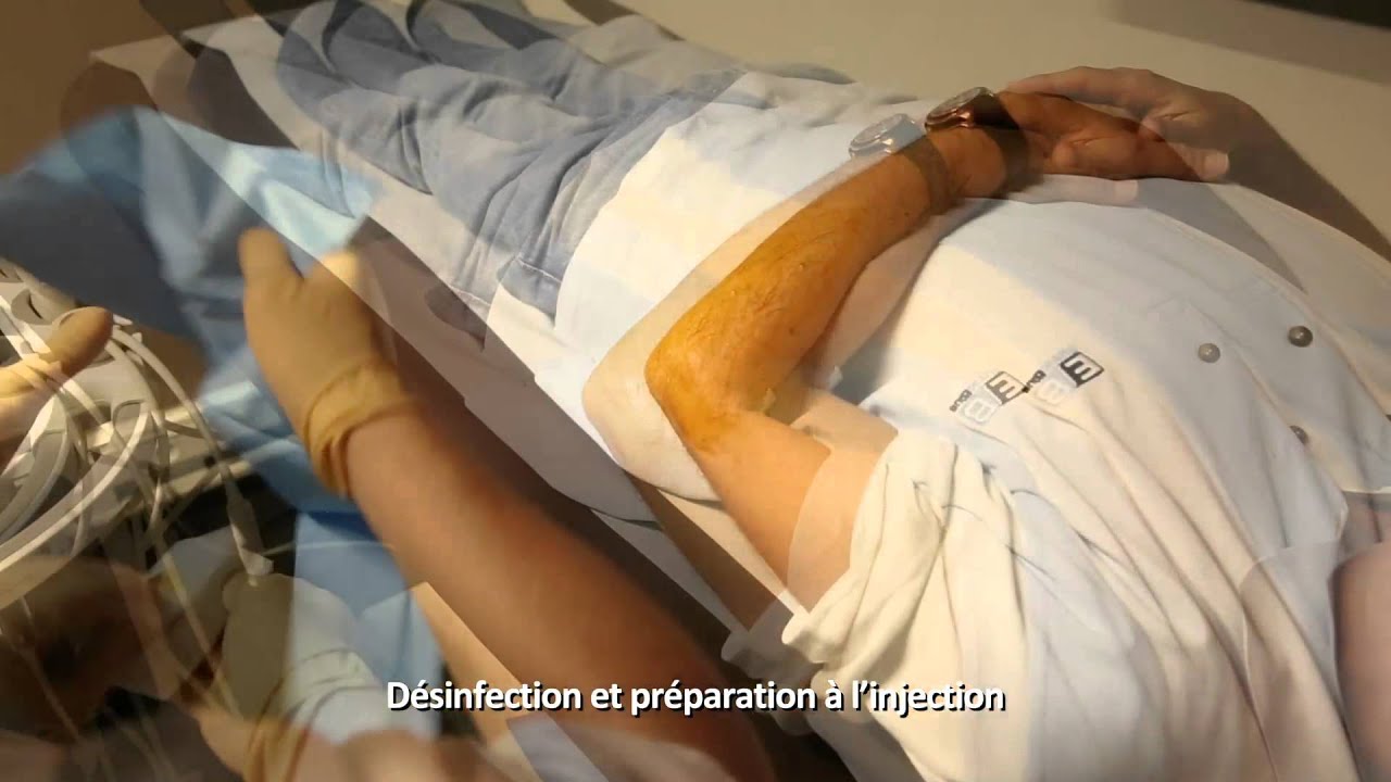 Traitement des tendinopathies fissuraires par injection de PRP