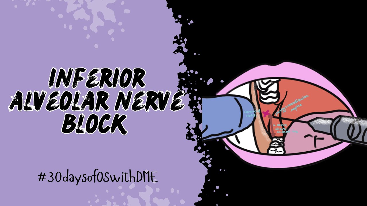 INFERIOR ALVEOLAR NERVE BLOCK || MANDIBULAR BLOCK || MADE EASY || 30daysofOSwithDME