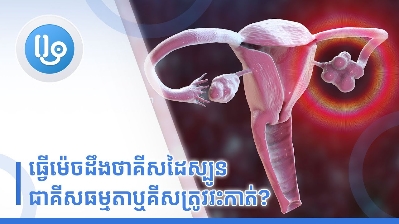 ធ្វើម៉េចដឹងថាគីសដៃស្បូនជាគីសធម្មតាឬគីសត្រូវវះកាត់?