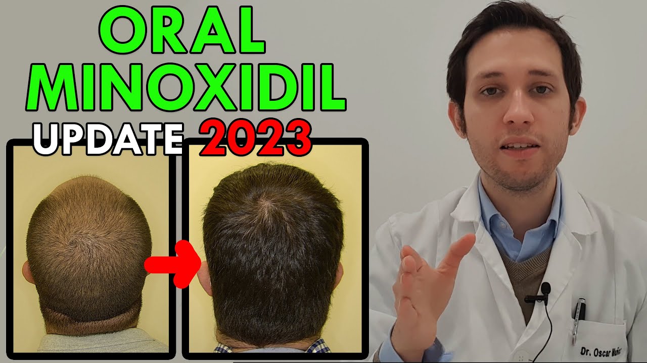 AVANCES en tratamiento CALVICIE no hormonal : MINOXIDIL ORAL 2023
