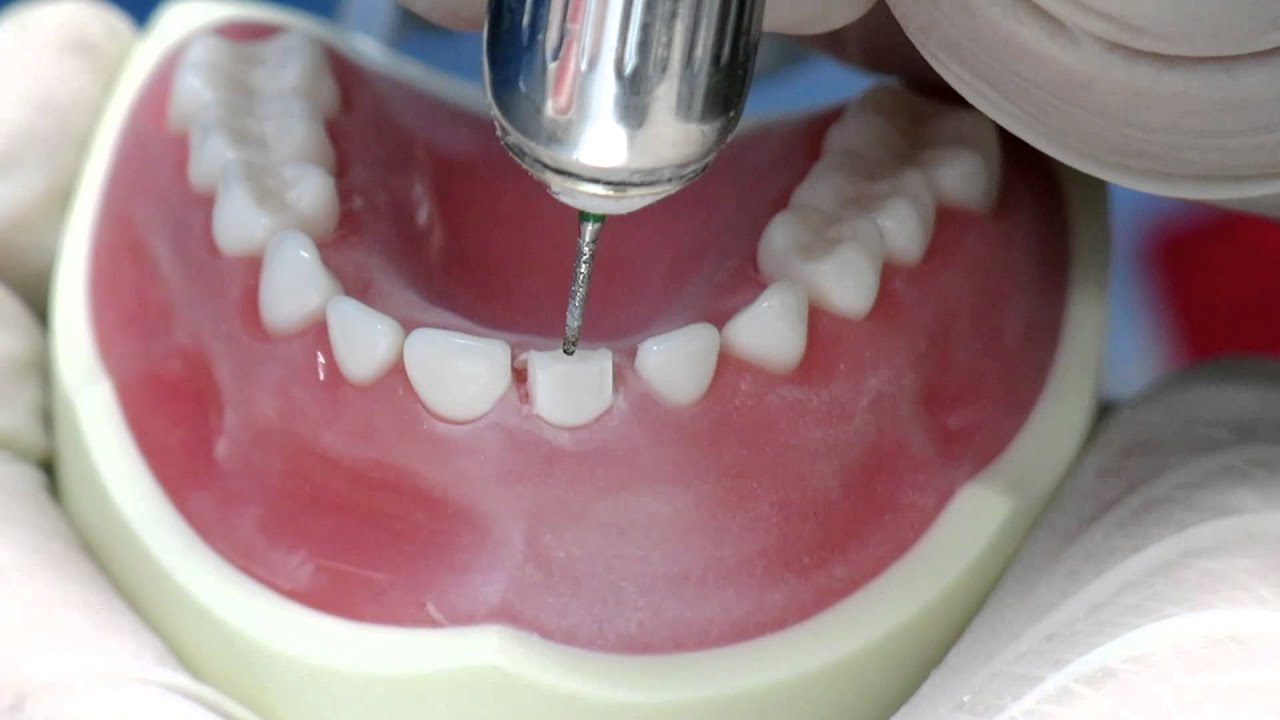 Zirconia Kinder Krowns - Anterior Technique