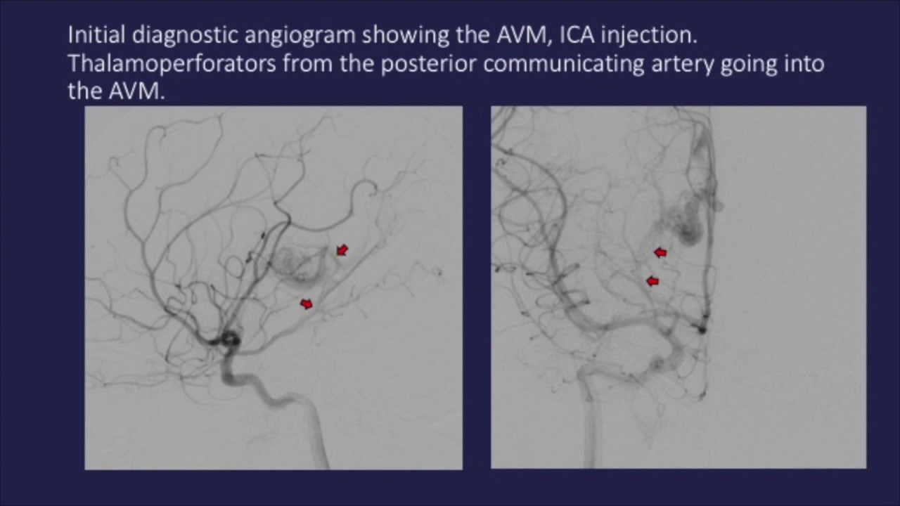 Transvenous embolization of thalamic arteriovenous malformation under transient cardiac standstill