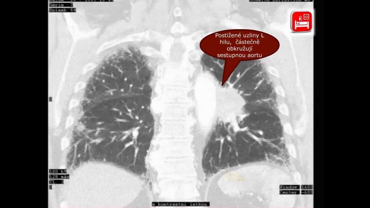 Plicní komplikace malobuněčného karcinomu plic – kazuistika