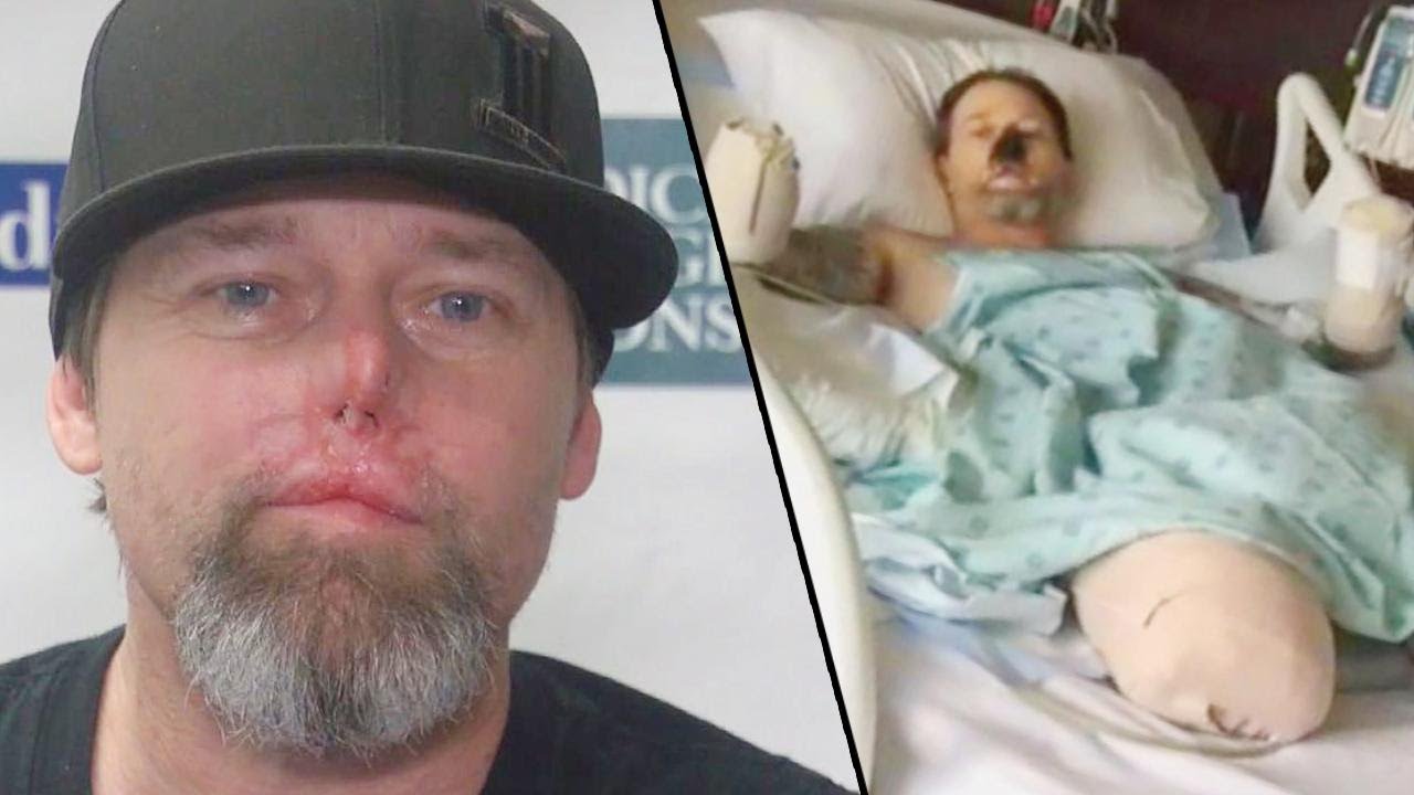 Wisconsin Man Who Lost Arms, Legs to Dog Lick Determined to Walk Again