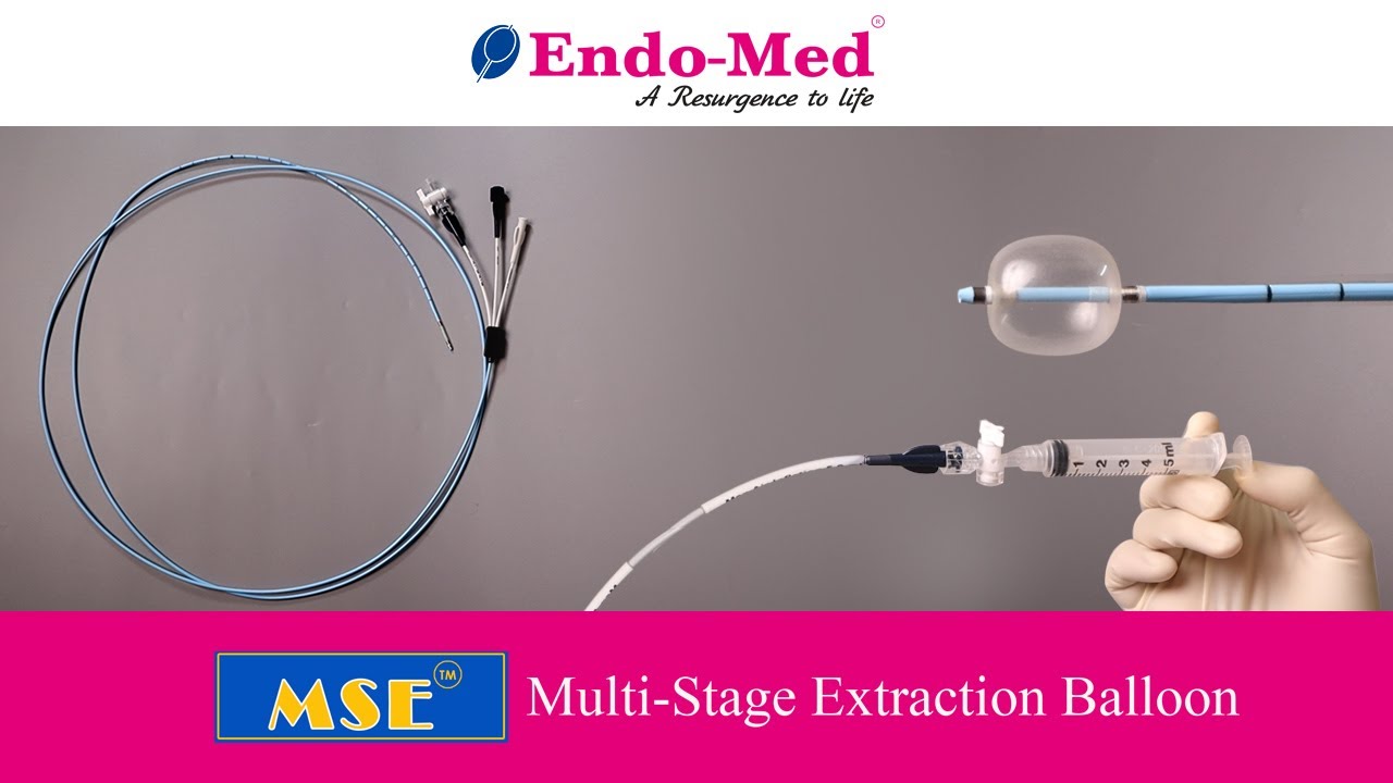 Multi-Stage Extraction Balloon | Endo-Med Technologies