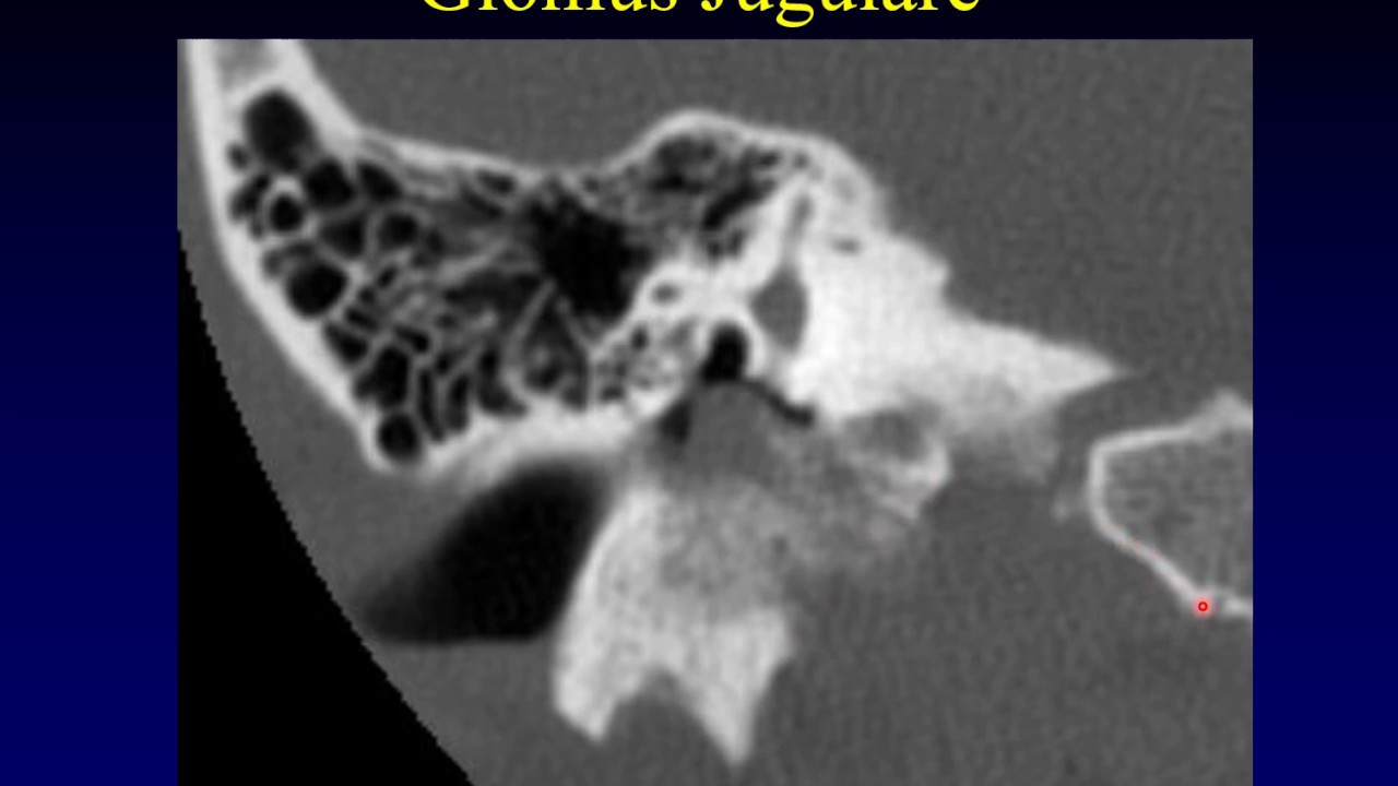 Temporal Bone Pathology 4:  Jugular Bulb