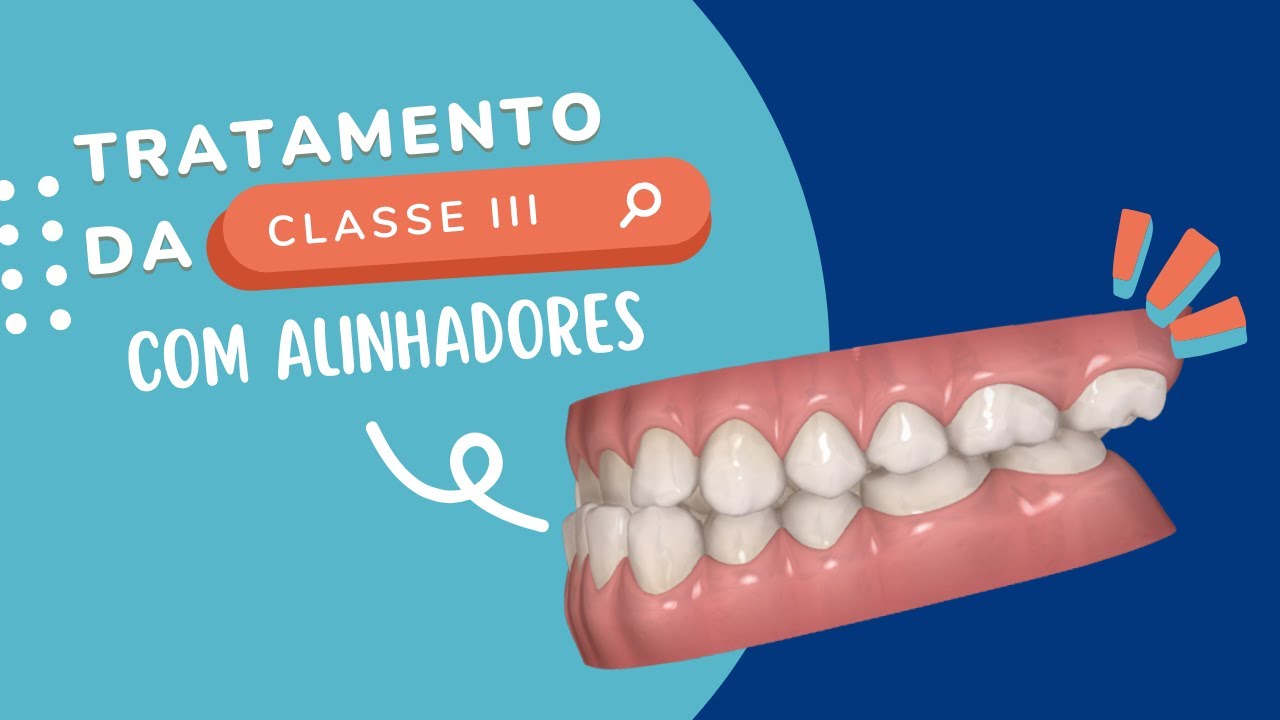 TRATAMENTO DA CLASSE III COM ALINHADORES - Prof Debora Aguiar