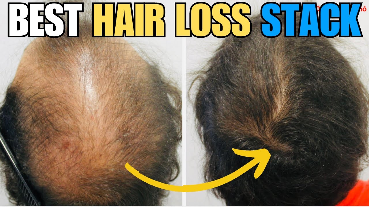 The BEST Hair Loss STACK- Dr. Sergio Vaño Europe's TOP Hair Loss Doctor