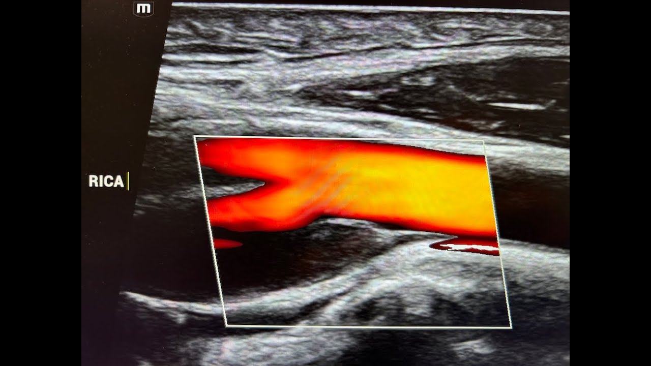 Zachary Lott, NP - The CIMT Test by CardioRisk Laboratories, and why it's my favorite.